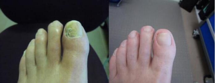 Fotografie nohou před a po použití krému Zenidol