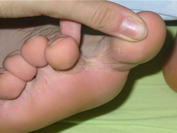 příznaky houby nehtů na nohou