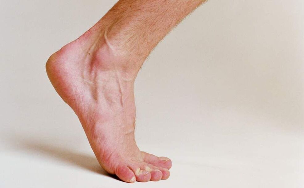 příznaky plísně na nohou