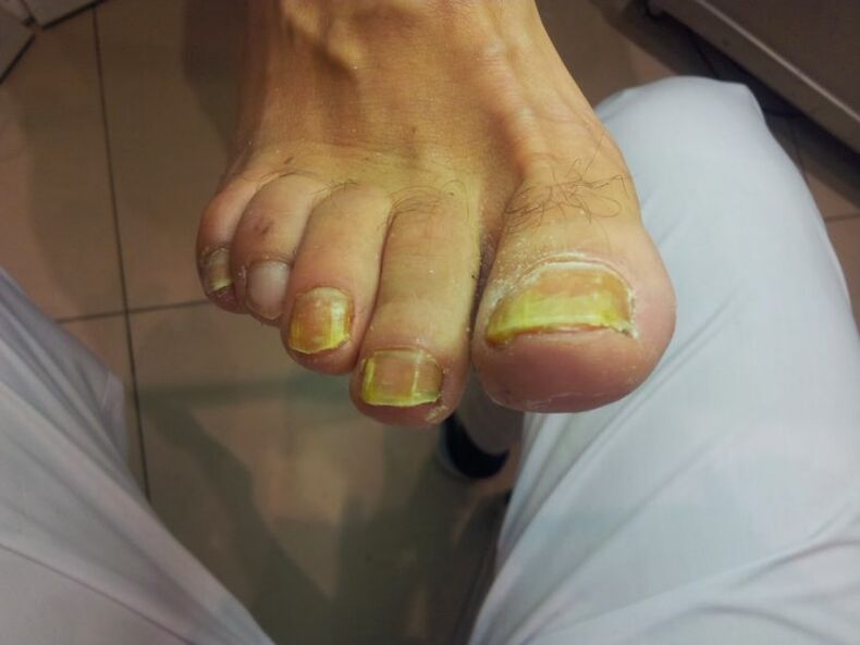 žluté nehty na nohou s plísní