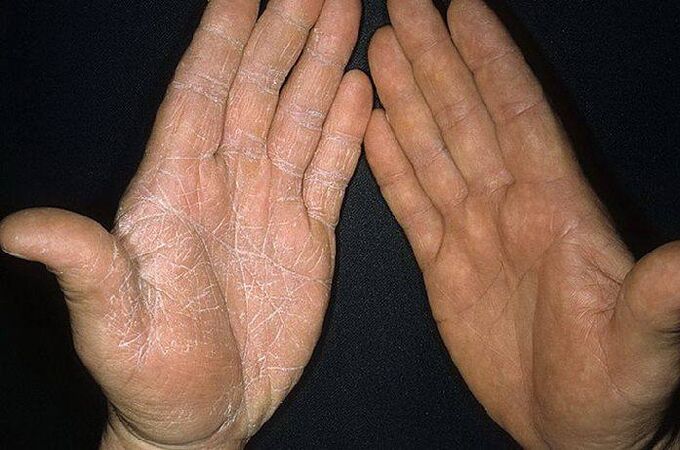 příznaky houby na kůži rukou