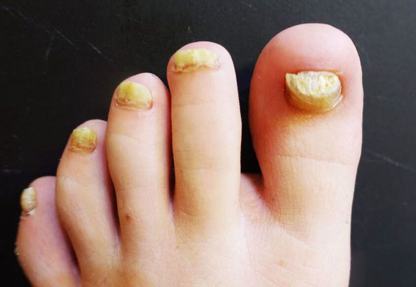 Nevzhledný vzhled nehtů na nohou postižených plísní