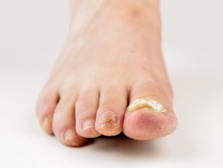 nehty na nohou postižené houbami