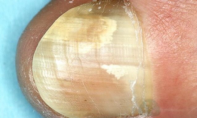 ošetření houby nehtů na nohou interními přípravky