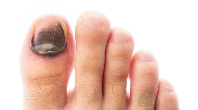pokročilé stádium onemocnění houbou nehtů na nohou
