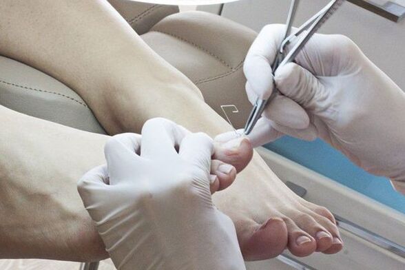 Mechanické odstranění nehtů na nohou postižených houbami