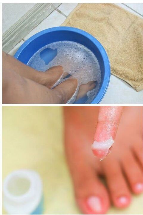 použití přírodních olejů při léčbě nehtů nehtů na nohou