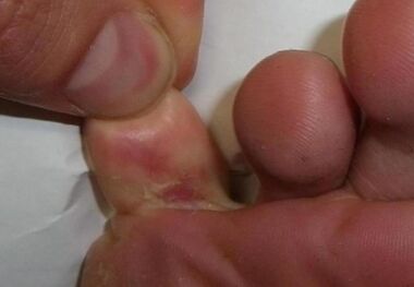 prasklina na noze je důsledkem plísňové infekce