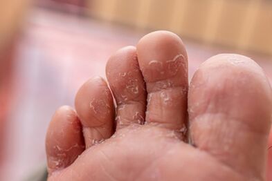 příznaky plísňových infekcí prstů na nohou